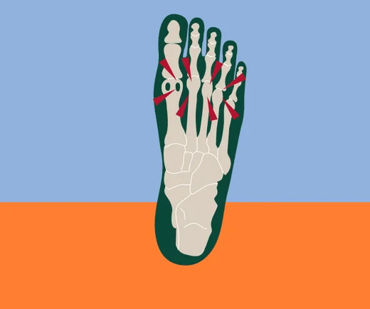 Best Insoles for Metatarsal Pain: Forefoot Cushioning and Arch Support