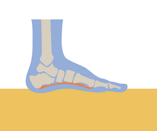 Plantar Fasciitis: Causes, Definition, and Treatment