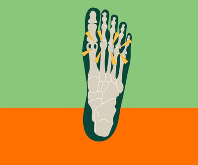 Metatarsalgia Exercises: Alleviate & Prevent Metatarsal Pain