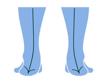 Best Insoles for Overpronation: Stability Arch Support and Deep Heel Cups